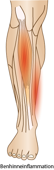 Benhinneinflammation