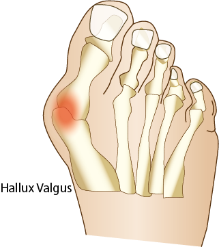 Hallux valgus - Snedställd stortå camp pro