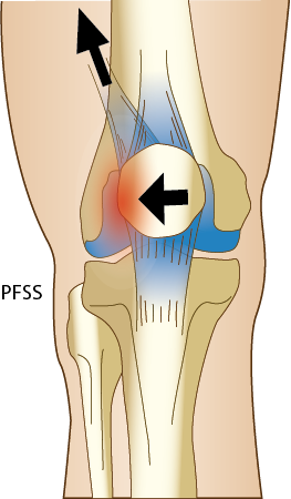 PFSS Patellofemoralt smärtsyndrom bild av knä 
