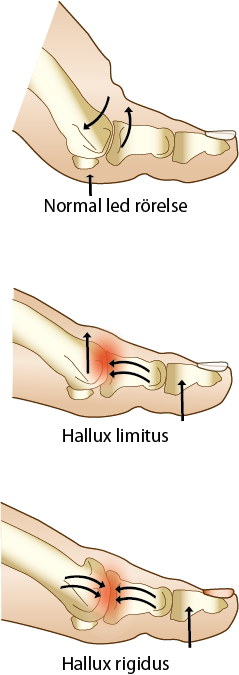 Hallux limitus Hallux rigidus Artros i tårna